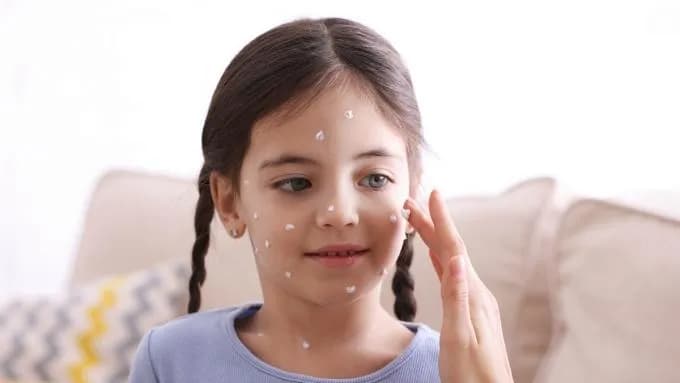 Skuteczne sposoby na ospę dla dziecka - jak złagodzić wszystkie objawy